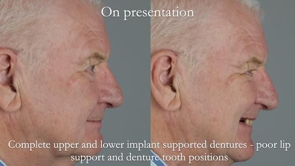 Newsletter 57 showcases the making and fitting process of implant-supported complete dentures for Alisdair