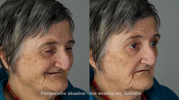 Newsletter 83: Sheila’s Complete Denture Success