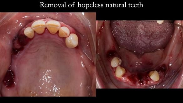 Finlay's Case Study Newsletter 40 - Immediate Mk 1 RPD to Definitive Mk 2 RPD - full protocol