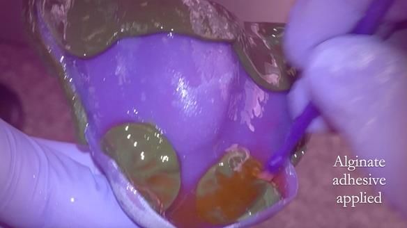 Finlay's Newsletter 62 provision of extractions and metal based complete dentures for Rafique