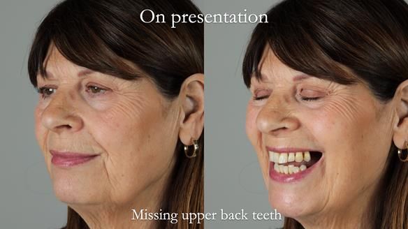 Newsletter 56 showing the making and fitting of a bilateral free end saddle upper removable partial denture (RPD) for patient with pemphigus