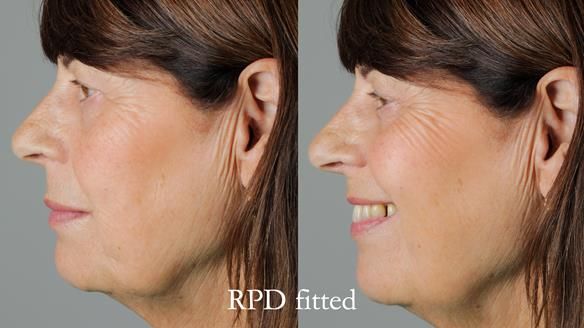 Newsletter 56 showing the making and fitting of a bilateral free end saddle upper removable partial denture (RPD) for patient with pemphigus