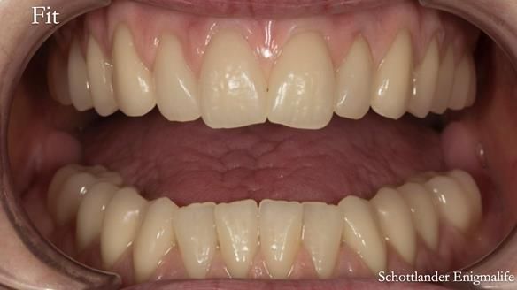 Newsletter 75: Marion’s case - Step-by-step complete denture workflow