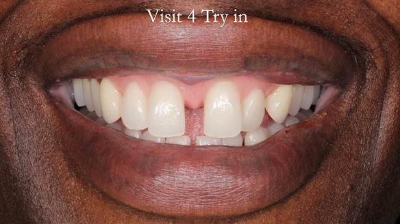 Newsletter 53 showing the making and fitting of ultra life-like dentures for Valena