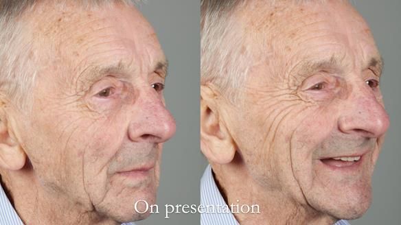 Newsletter 80 - Gordon’s dentures: the one case in 1,000 where my technique failed