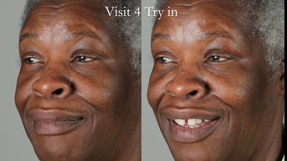 Newsletter 53 showing the making and fitting of ultra life-like dentures for Valena