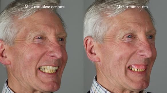 Newsletter 77: Jeremy’s case – immediate complete upper denture