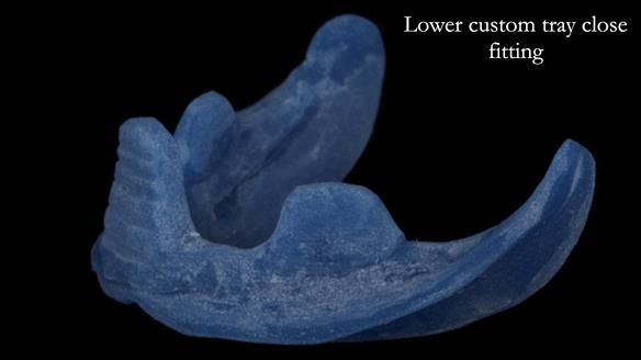 Newsletter 83: Sheila’s Complete Denture Success