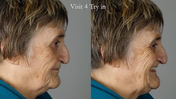 Newsletter 83: Sheila’s Complete Denture Success