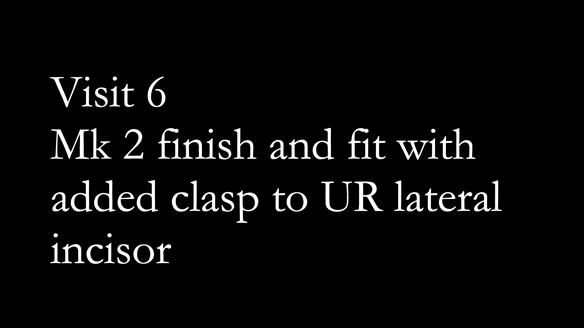 Newsletter 51 Managing Anne’s failing dentition with distal extension base RPD/Splint FULL PROTOCOL
