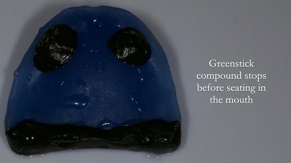 Newsletter 83: Sheila’s Complete Denture Success