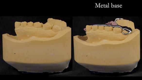 Upper metal base partial denture/occlusal stabilisation splint/obturator - full protocol