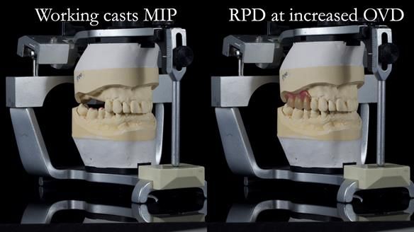 Finlay's Newsletter 64 case study - provision of a Kennedy class 2 metal based Scandinavian RPD for Ian
