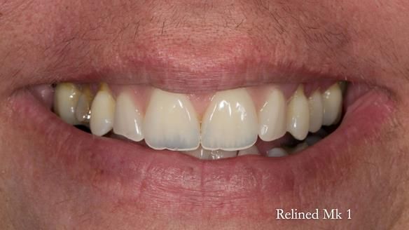 Finlay's Newsletter 63 Case study provision of metal based Scandinavian RPD - functional 10 years on