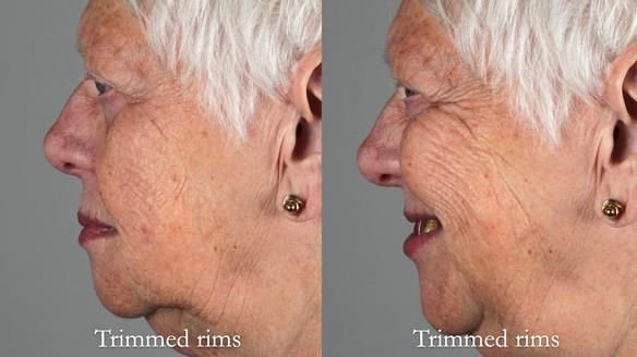 Finlay's Newsletter 59 Ultra hard partial dentures made for Gill