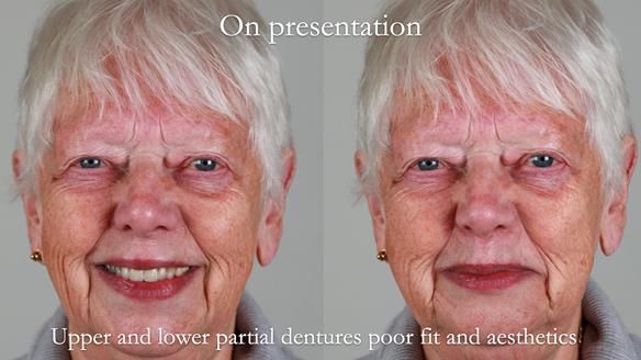 Finlay's Newsletter 59 Ultra hard partial dentures made for Gill