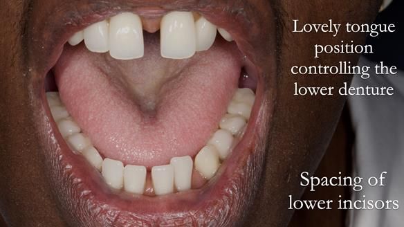 Newsletter 53 showing the making and fitting of ultra life-like dentures for Valena