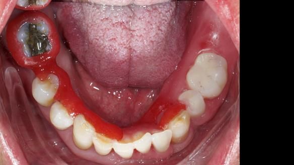 Newsletter 86 Peter the Architect — precision removable partial dentures case study
