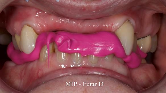 Newsletter 81 - Pam’s Story — how a partial denture changed her life (+ live walkthrough this Thursday)