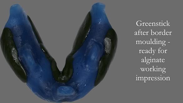 Newsletter 53 showing the making and fitting of ultra life-like dentures for Valena