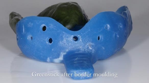 Finlay's Newsletter 64 case study - provision of a Kennedy class 2 metal based Scandinavian RPD for Ian