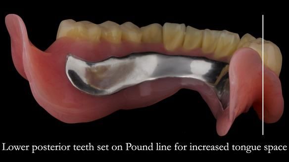 Complete denture Class II div 2 deep overbite Newsletter 39