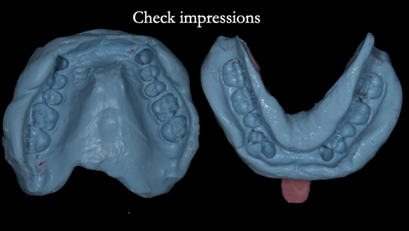  Figure 56 Check impression to assess preparation of the teeth for occlusal space for the rests