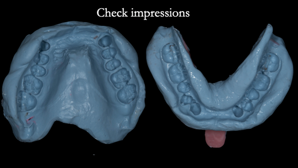 Figure 56 Check impression to assess preparation of the teeth for occlusal space for the rests