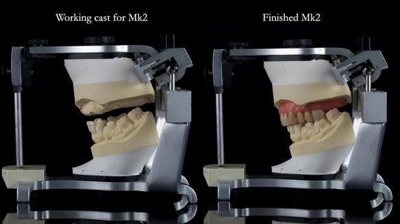 Newsletter 77: Jeremy’s case – immediate complete upper denture