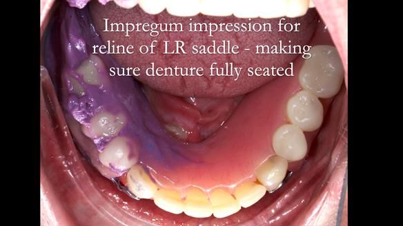 Newsletter 52 Managing Jo’s failing dentition with extractions and Mk 1/Mk 2 complete upper dentures and lower partial dentures FULL PROTOCOL