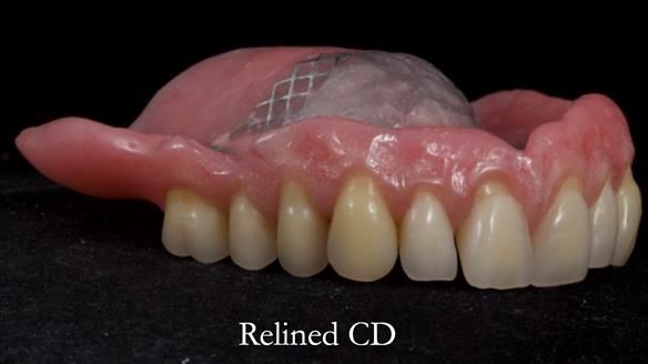 Finlay's Newsletter 62 provision of extractions and metal based complete dentures for Rafique