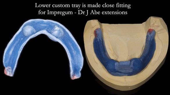 Newsletter 78: What do Clark Gable and a Locator® overdenture have in common?