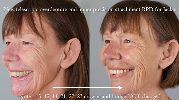 Newsletter 76: Jackie’s case – Telescopic overdenture & precision RPD (the tricky truth!)
