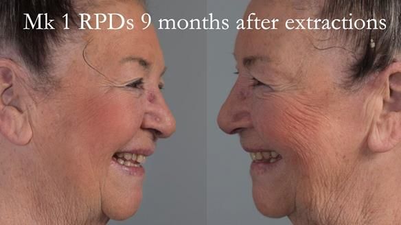 Finlay's Case Study Newsletter 40 - Immediate Mk 1 RPD to Definitive Mk 2 RPD - full protocol