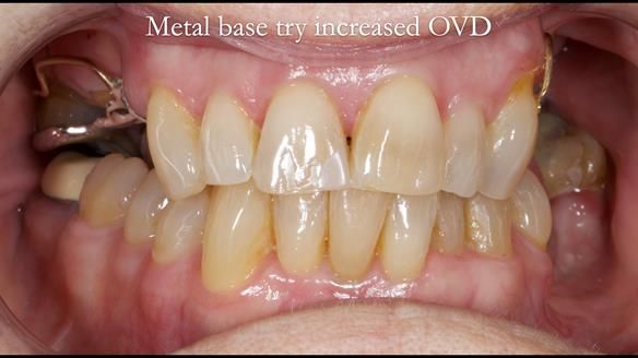 Finlay's Newsletter 60 Sylvia's upper Kennedy Class 2 Mod 1 metal based upper RPD