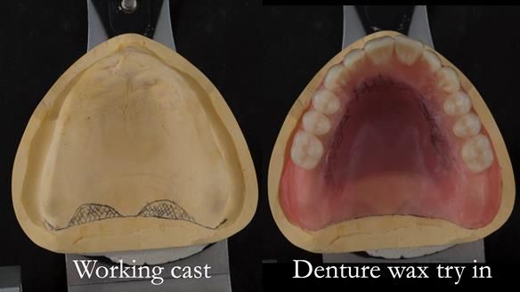 Newsletter 75: Marion’s case - Step-by-step complete denture workflow