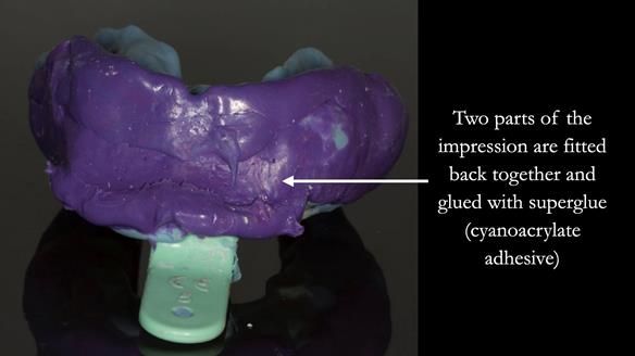 Finlay's Case Study Newsletter 40 - Immediate Mk 1 RPD to Definitive Mk 2 RPD - full protocol