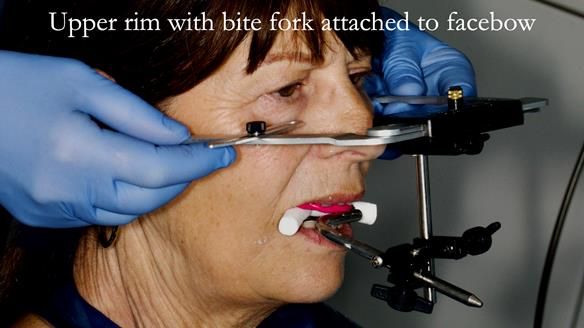 Newsletter 56 showing the making and fitting of a bilateral free end saddle upper removable partial denture (RPD) for patient with pemphigus