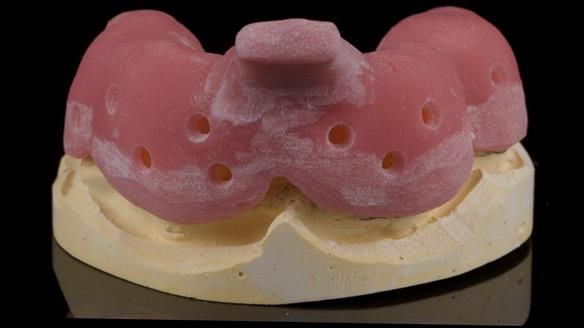 Newsletter 77: Jeremy’s case – immediate complete upper denture