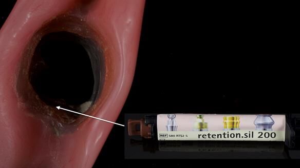 Newsletter 82 Mary - A complete upper and a one-tooth gasket denture