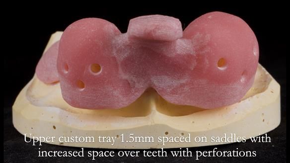 Finlay's Newsletter 59 Ultra hard partial dentures made for Gill