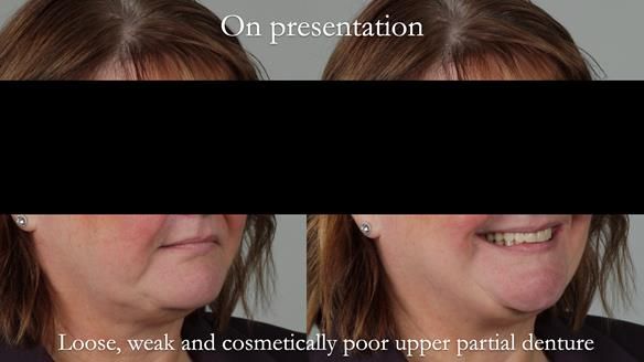 Finlay's Newsletter 58 Gasket upper partial denture for Zoe