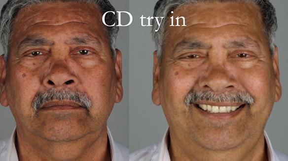 Finlay's Newsletter 62 provision of extractions and metal based complete dentures for Rafique