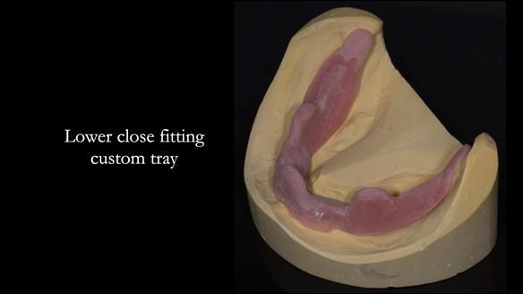 Newsletter 75: Marion’s case - Step-by-step complete denture workflow