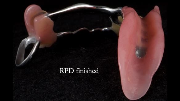 Newsletter 55 Provision of metal based partial dentures for Zephyrine with a repaired cleft lip and palate