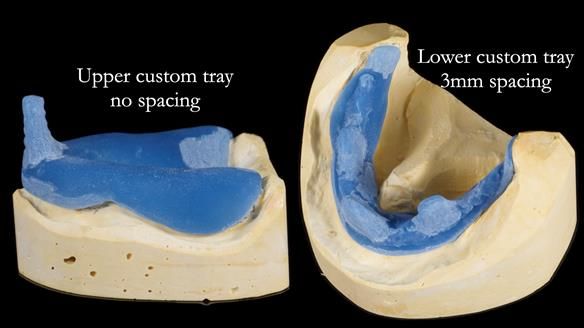Newsletter 80 - Gordon’s dentures: the one case in 1,000 where my technique failed
