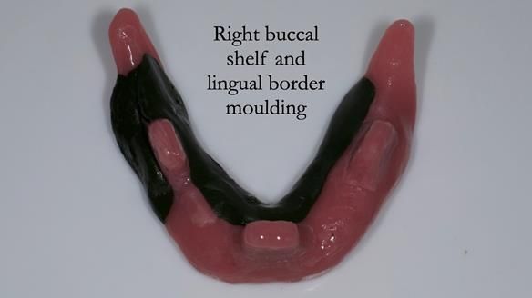 Newsletter 44 - extreme removable prosthodontics – engineering a super-strong and ultra-thin over denture