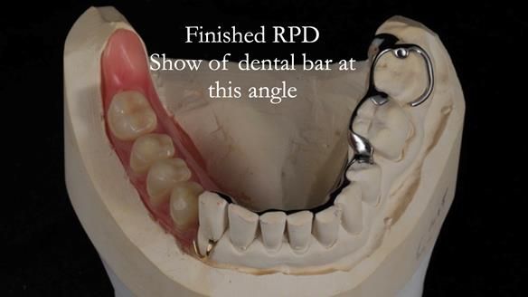 Finlay's Newsletter 61 provision of a lower unilateral free end saddle metal based partial denture for Joyce