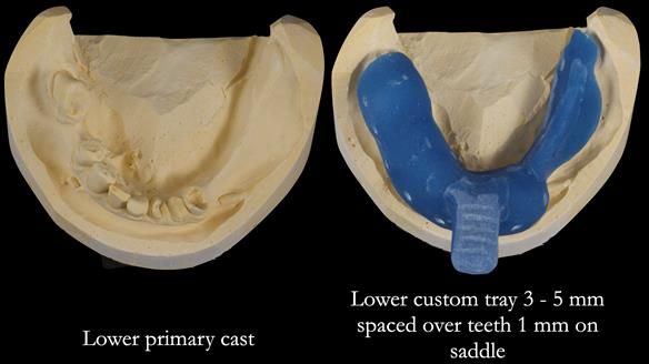 Newsletter 55 Provision of metal based partial dentures for Zephyrine with a repaired cleft lip and palate