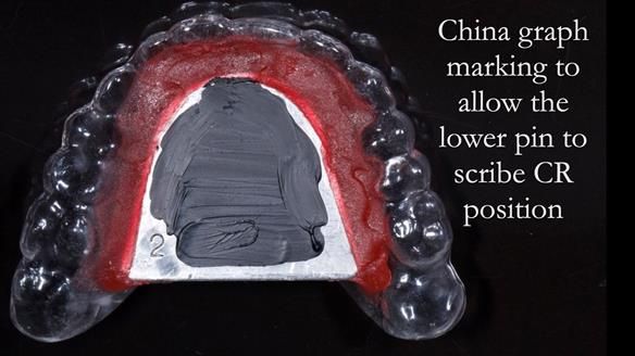 Newsletter 44 - extreme removable prosthodontics – engineering a super-strong and ultra-thin over denture